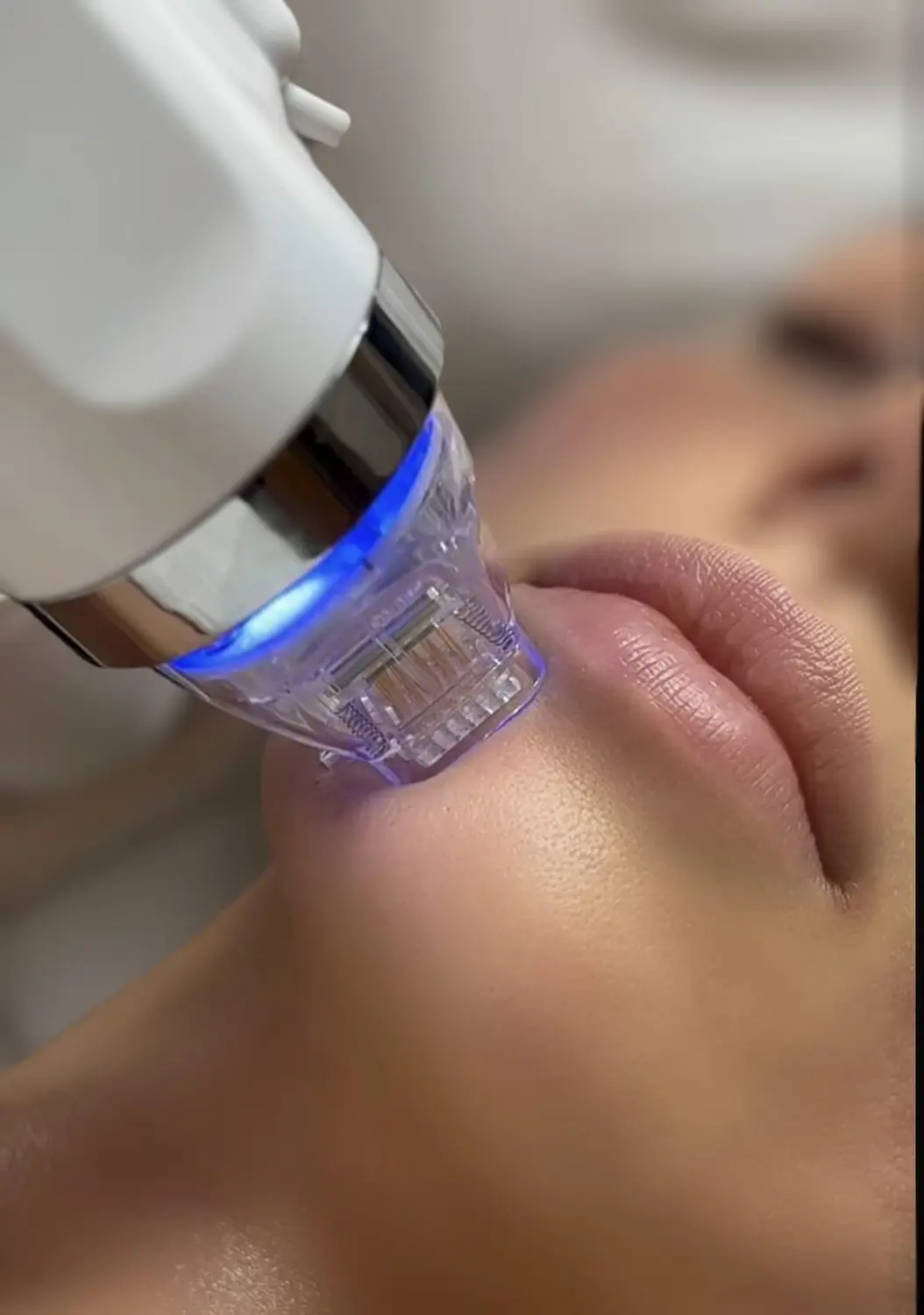Milo's beauty oasis - Microneedling