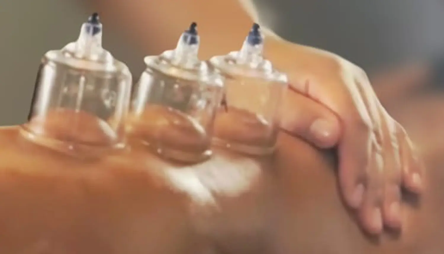 Milo's beauty oasis - Schröpfen therapie