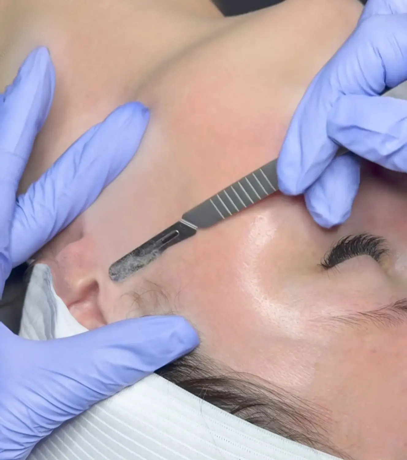 Milo's beauty oasis - Dermanplaning